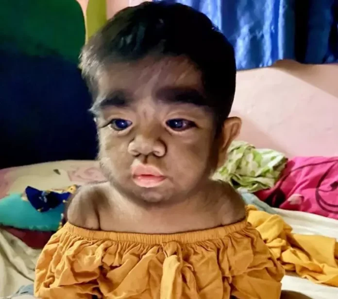 Bebê com hipertricose devido à exposição ao minoxidil