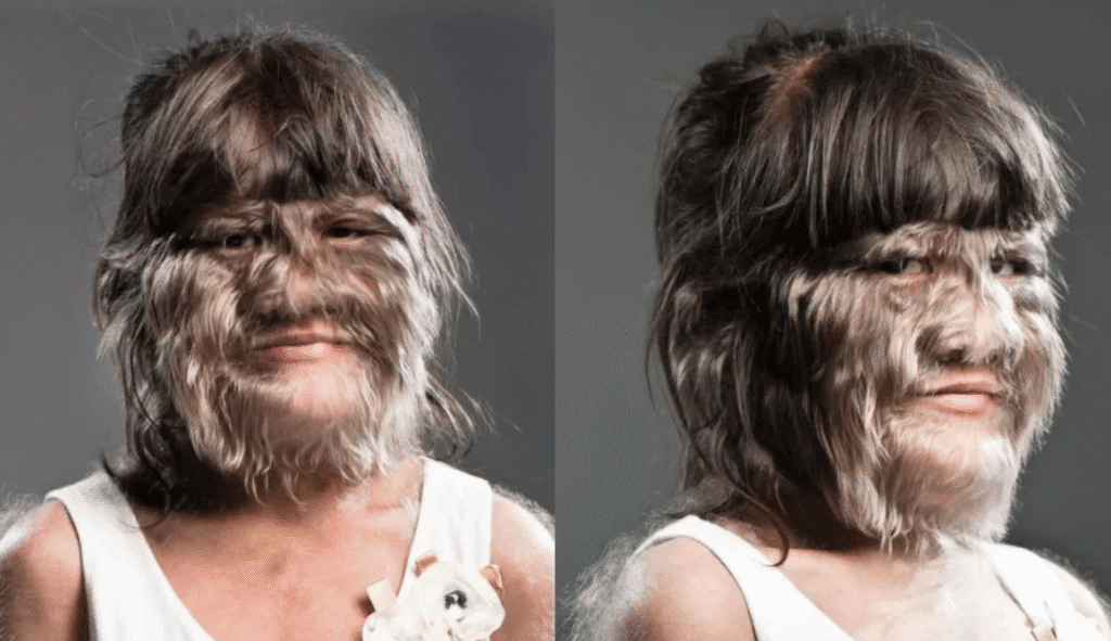 Síndrome do Lobisomem: Entenda os Riscos do Minoxidil para Crianças 1 Síndrome do Lobisomem: Entenda os Riscos do Minoxidil para Crianças hipertricose devido à exposição ao minoxidil